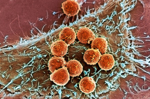 Scanning electron microscope image of T cells (orange) attached to a tumour cell.